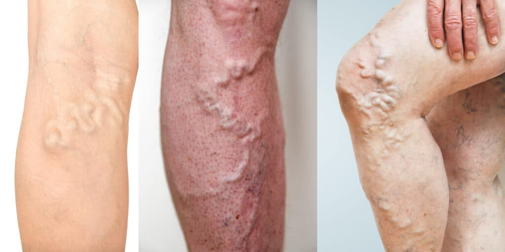 <p>A condition in which a <strong>blood clot forms in a deep vein</strong>, usually in the <strong>leg</strong>.</p>