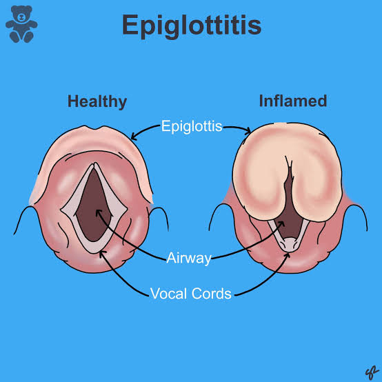 <p>Definition: Inflammation of the epiglottis</p><p>Symptoms:</p><ul><li><p>Severe sore throat</p></li><li><p>Stridor</p></li><li><p>High fever</p></li><li><p>4Ds:</p><ul><li><p>Dysphonia</p></li><li><p>Drooling</p></li><li><p>Dysphagia</p></li><li><p>Distress</p></li></ul></li></ul><p></p>