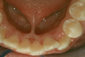 <p>abnormally short, thick lingual frenum resulting in limitation of tongue movement </p>