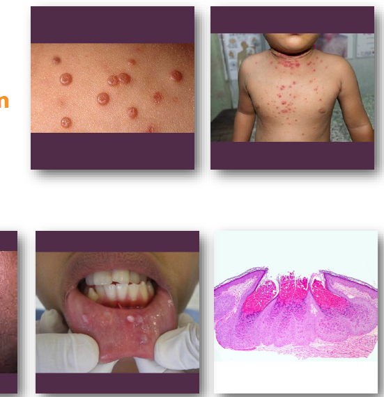 <p>• Many lesions resolve spontaneously over time</p><p>•Curettage or cryotherapy for persistent lesions</p><p>•Biopsy recommended for oral involvement</p><p>•Address underlying immunosuppression if present</p><p>•Excellent prognosis with self-limited course</p>