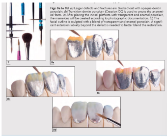 <p>In 1887, the first successful porcelain jacket crown was attributed to Charles Land who patented his <strong>platinum matrix technique.</strong> </p><p>The adaptation of the platinum matrix method subsequently allowed for the production of <strong>ceramic inlays</strong> which were <strong>cemented</strong> into prepared cavities.</p>