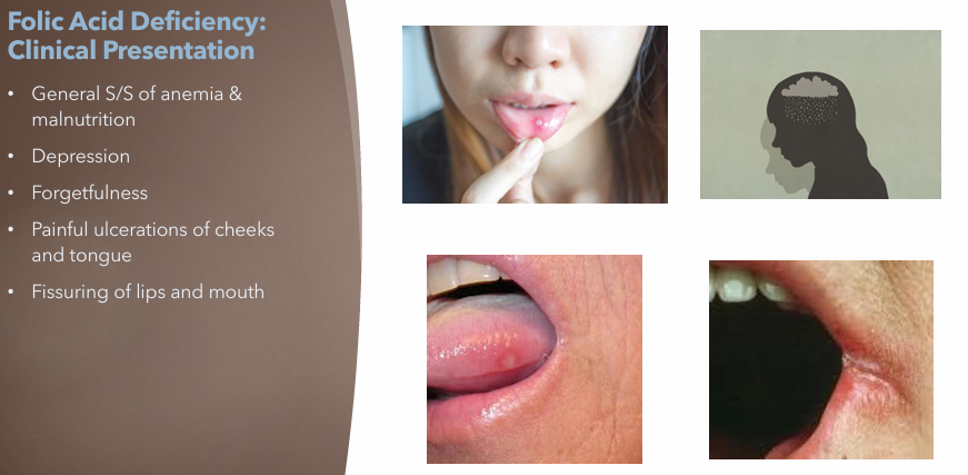 <ul><li><p>General S/S of Anemia</p></li><li><p>Malnutrition</p></li><li><p>Depression</p></li><li><p>Forgetfulness</p></li><li><p>Painful ulcerations of cheeks and tongue</p></li><li><p>Fissuring of lips and mouth</p></li></ul><p></p>