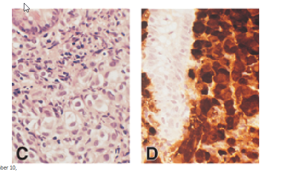 <p><span style="background-color: transparent;">Tumor Markers</span></p><ul><li><p><span style="background-color: transparent;">Immunohistochemistry (IHC)&nbsp;</span></p><ul><li><p><span style="background-color: transparent;">identify specific proteins in tissue sample</span></p></li></ul></li><li><p><span style="background-color: transparent;">Antibodies bind target antigens on tissue</span></p></li><li><p><span style="background-color: transparent;">Cytokeratin stain (B): carcinoma</span></p></li><li><p><span style="background-color: transparent;">S-100 stain (D): melanoma</span></p></li></ul><p></p>
