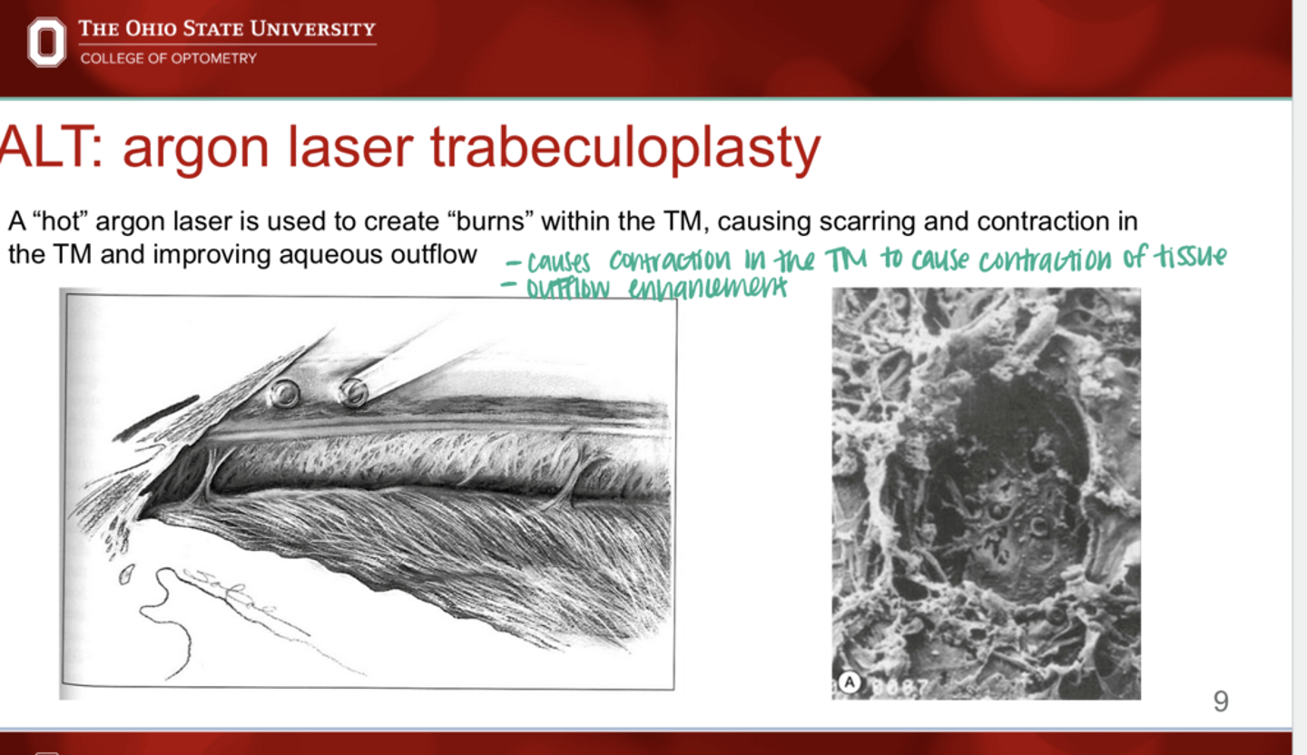<p>What is the expected efficacy of ALT (argon laser trabeculoplasty)?</p>