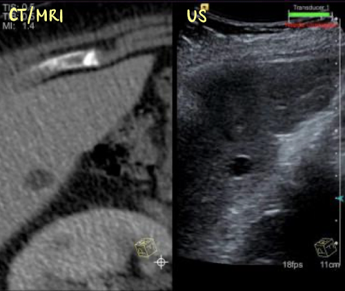<ul><li><p>involves important a CT or MRI scan directly onto the US machine</p><ul><li><p>side by side images</p></li><li><p>superimposed/overlapping images</p></li></ul></li><li><p>as the US machine moves, so does the other imported modality images</p></li></ul><p></p>