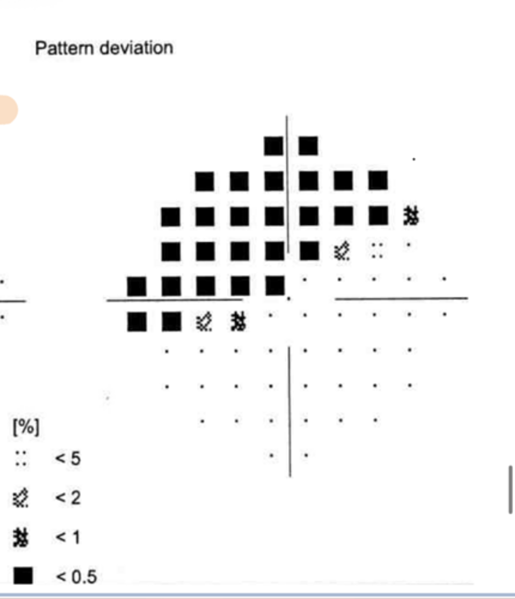 <p>Pattern Deviation VF Plot for IT Drance Hemorrhage</p>