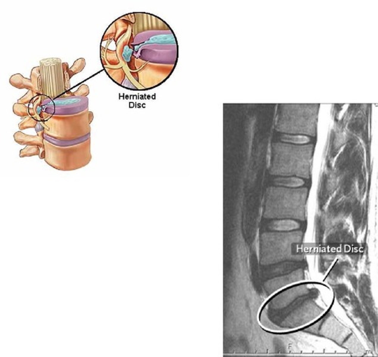 <p>displacement of nucleus pulposus due to weakness of annulus fibrosus (which cracks with age and under excess force) displaced disk can put pressure on adjacent nerves.</p>