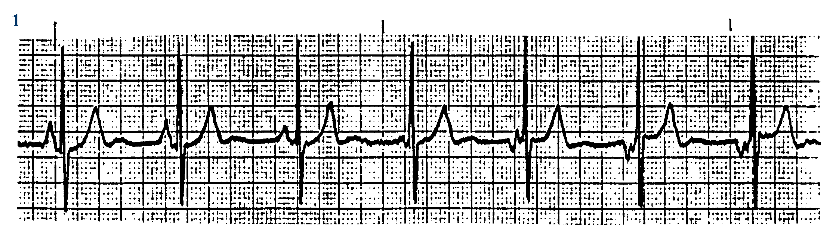 <p>What ECG is this? </p>