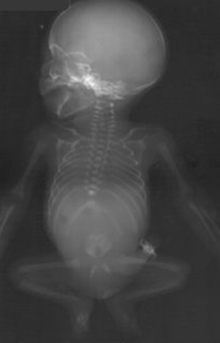 <ul><li><p>rare disorder that represents a range of malformations of caudal end of neural tube</p><ul><li><p>complete or partial agenesis of the sacrum and coccyx</p></li></ul></li><li><p>associated with</p><ul><li><p>VACTERL</p></li><li><p>GI, GU, CNS, and cardiac anomalies</p></li></ul></li><li><p>poor prognosis</p></li></ul><p></p>