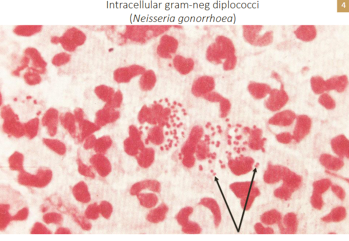 <p>- Neisseria gonorrhea</p>