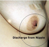 <p>What pathology usually presents with this type of discharge?</p>