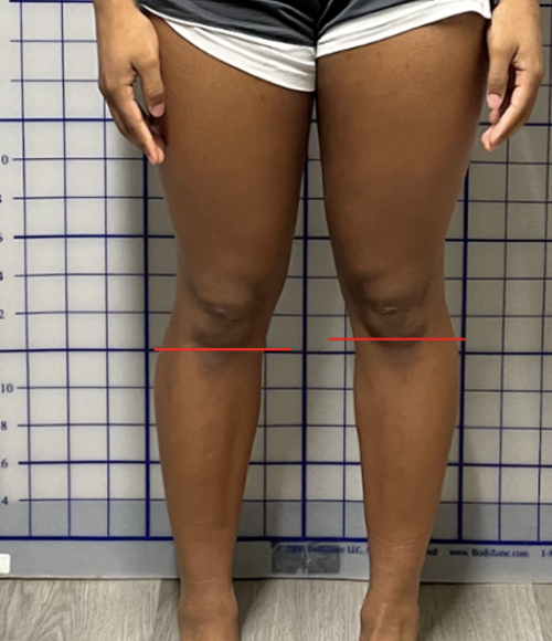 <p>patellar alignment: why?</p>