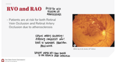 <p>When retinal arteries thicken/stiffen, how does this lead to a RVO?</p>