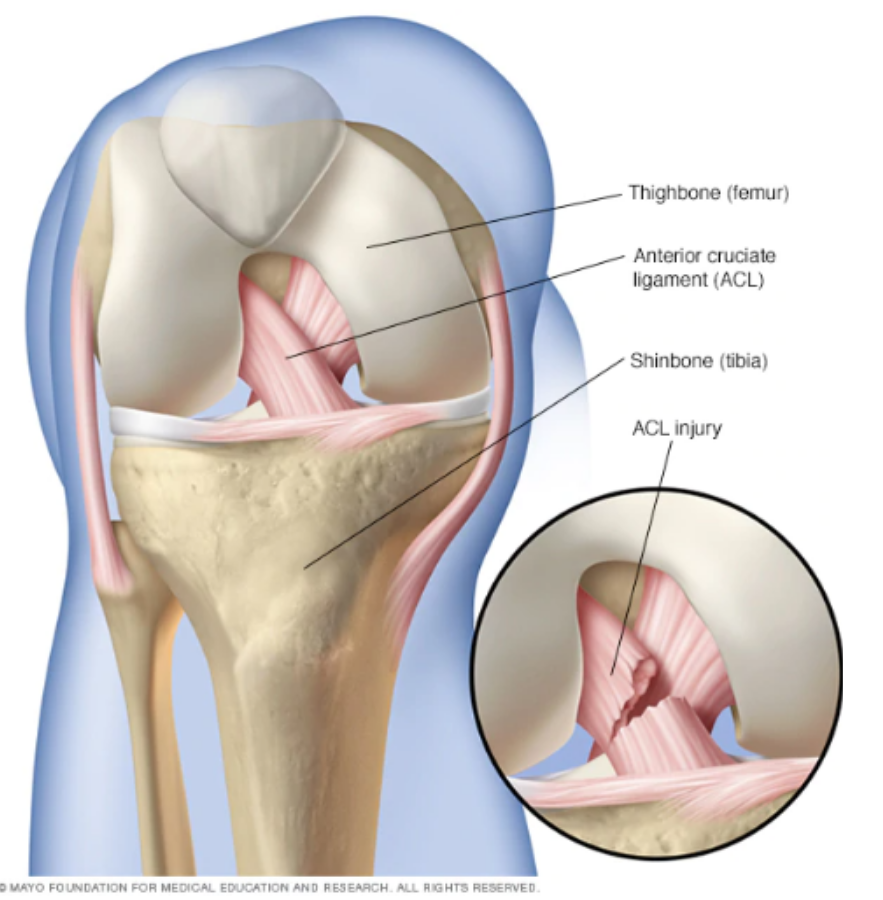 <p>Central stabilizer routinely resected during TKA.</p>