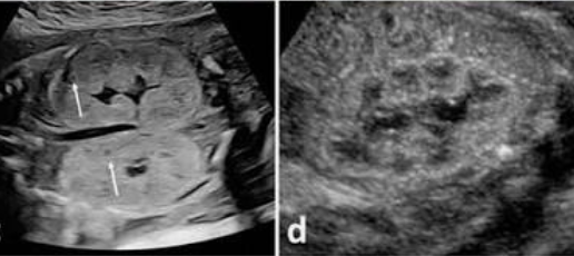 <ul><li><p>symmetrically enlarged kidneys </p></li><li><p>microscopic kidneys </p></li><li><p>diffuse echogenicity </p></li><li><p>poor cortico-medullary differentiation </p></li></ul><p></p>