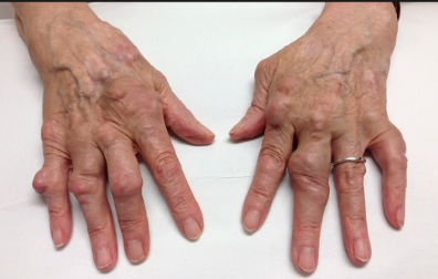 <p>image showing classic rheumatoid arthritis hands </p>