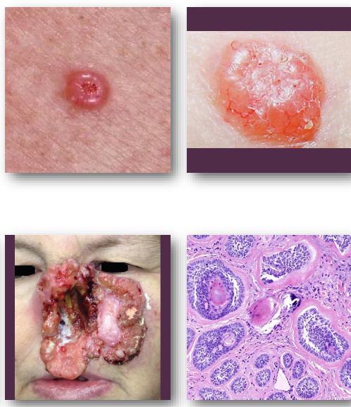 <ul><li><p><strong>pearly papule with rolled and raised borders</strong></p></li><li><p><strong>central ulceration</strong> may be present </p></li><li><p>surface shows fine blood vessels</p></li><li><p><strong>common on face and nose region</strong></p></li><li><p>slow-growing but locally destructive</p></li></ul><p></p>
