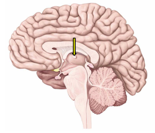 <p>Which statement(s) is/are true regarding the structure indicated by the arrow?</p><p>i. Is part of the thalamus.</p><p>ii. Is part of the hypothalamus.</p><p>iii. Is the interthalamic adhesion (massa intermedia).</p><p>iv. Is the infundibulum.</p>