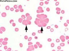 <p>Autoantibodies, cold autoagglutinin</p>