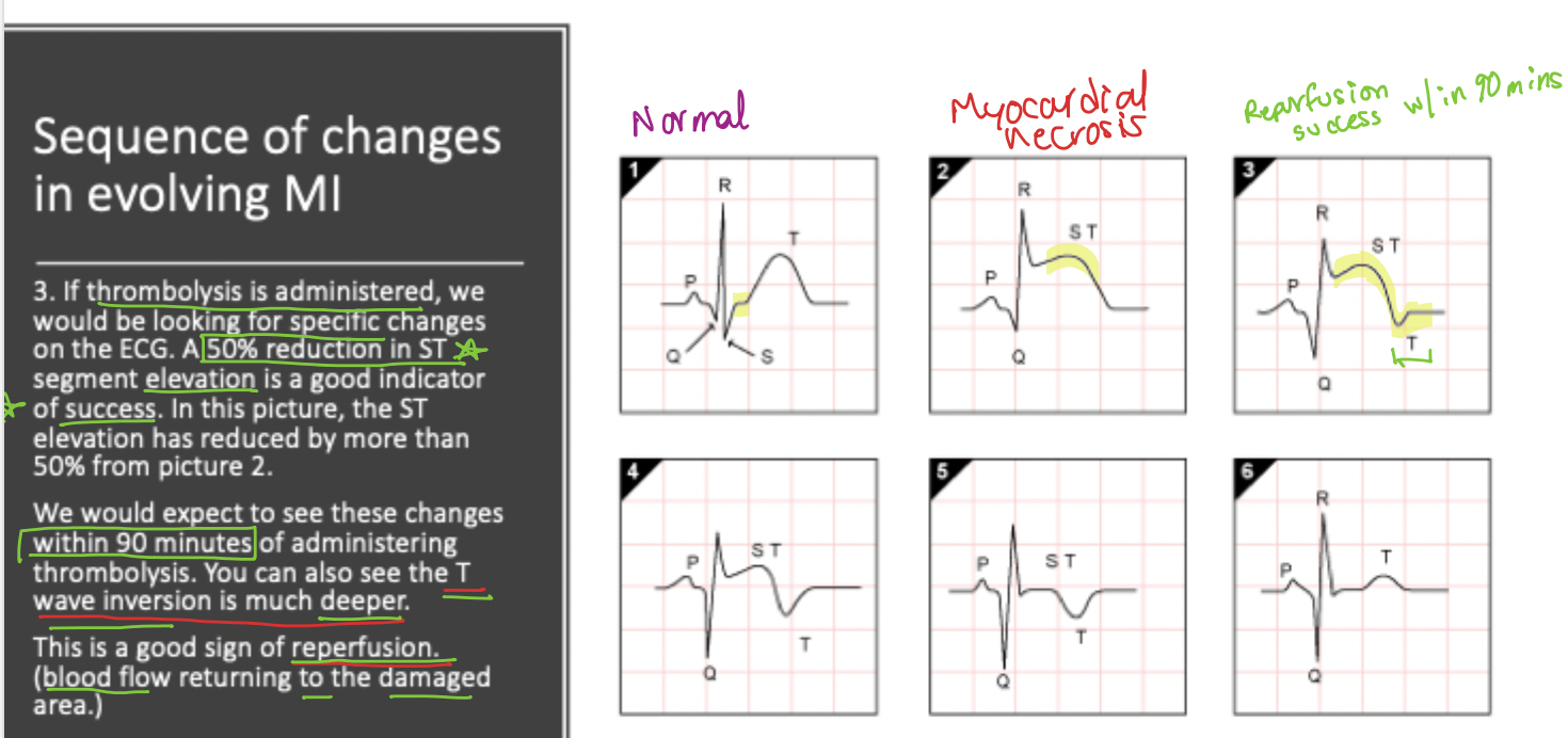<p>A <strong>$$50\%$$ reduction in ST</strong> <strong>elevation</strong> and <strong>deep T-wave inversion = success</strong></p>