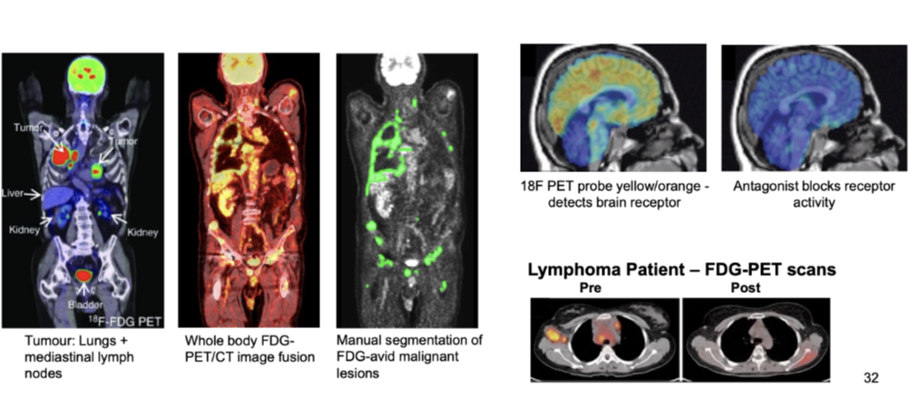 <ul><li><p>Sequential <strong>FDG-PET imaging</strong> in advanced cancer is often a more accurate predictor of treatment response than clinical or histopathological criteria</p></li><li><p>Detects <strong>metabolically active tumour sites</strong></p></li><li><p>Combining <strong>PET and CT</strong>:</p><ul><li><p>Visualises active tumour regions</p></li><li><p>Shows where cancer has <strong>metastasised</strong></p></li></ul></li><li><p>Applications:</p><ul><li><p>Whole body <strong>FDG-PET/CT image fusion</strong></p></li><li><p>Identification and manual segmentation of <strong>FDG-avid malignant lesions</strong></p></li><li><p>Example: tumours in <strong>lungs and mediastinal lymph nodes</strong></p></li></ul></li><li><p>Can assess <strong>treatment response</strong> (e.g. lymphoma pre vs post scans)</p></li><li><p>Other tracers:</p><ul><li><p><strong>18F PET probe</strong> detects brain receptor activity (yellow/orange)</p></li><li><p><strong>Antagonist blocks receptor activity</strong></p></li></ul></li></ul><p></p>