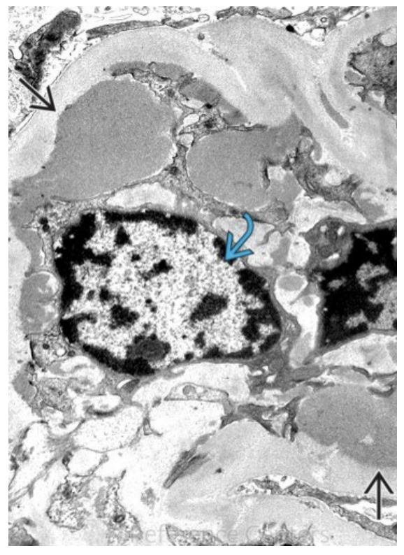 <p>A 19-year-old college student presents to the clinic with recurrent episodes of dark, “tea-colored” urine. He reports that the episodes typically begin within 24–48 hours after an upper respiratory tract infection. Between episodes, he feels well and his urine returns to normal color. He has no edema, no rash, and no joint pain. Blood pressure is 118/76 mmHg. Urinalysis during an episode shows hematuria with red blood cell casts and mild proteinuria. Serum creatinine is normal. Complement levels (C3 and C4) are within normal limits. A renal biopsy is performed. Light microscopy shows mesangial hypercellularity. Immunofluorescence microscopy demonstrates a granular pattern of immune complex deposition within the mesangium. Electron microscopy reveals electrondense deposits located in the mesangial region as shown in the image attached. Which of the following best describes the underlying mechanism of this disease?</p>