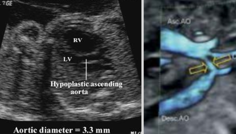 <ul><li><p><span style="background-color: transparent;">Narrowing of aortic lumen</span></p></li><li><p><span style="background-color: transparent;">US findings:&nbsp;</span></p><ul><li><p><span style="background-color: transparent;">Narrowed aortic arc</span></p></li><li><p><span style="background-color: transparent;">Disproportionate ventricle sizes</span></p></li></ul></li></ul><p></p>