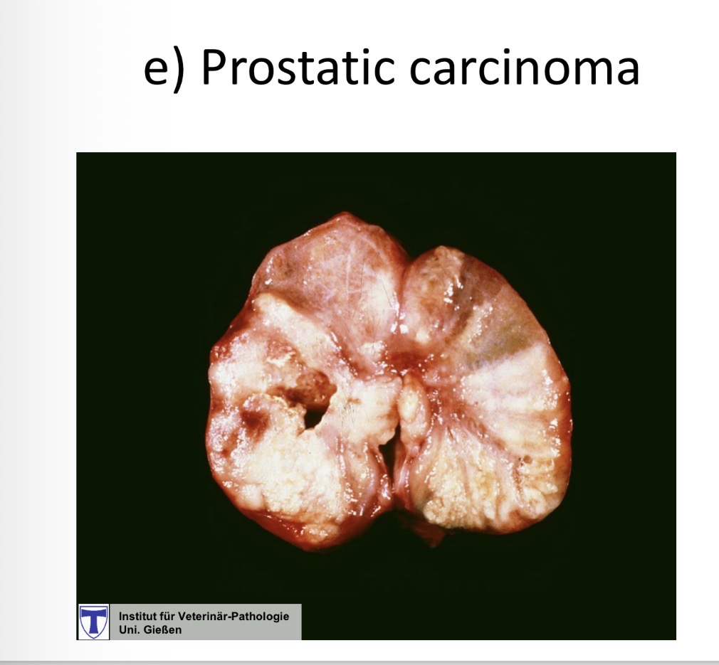 <p>[prostatic carcinoma gross </p>