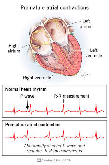 <p>premature atrial beat</p>