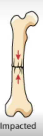 <p>bone fragments are driven into each other</p>