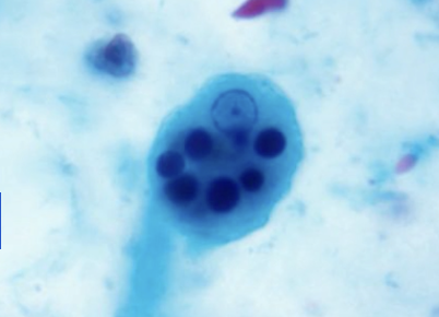 <p>On histology, _______________ presents as <strong>trophozoites that contain endocytosed RBCs.</strong></p>