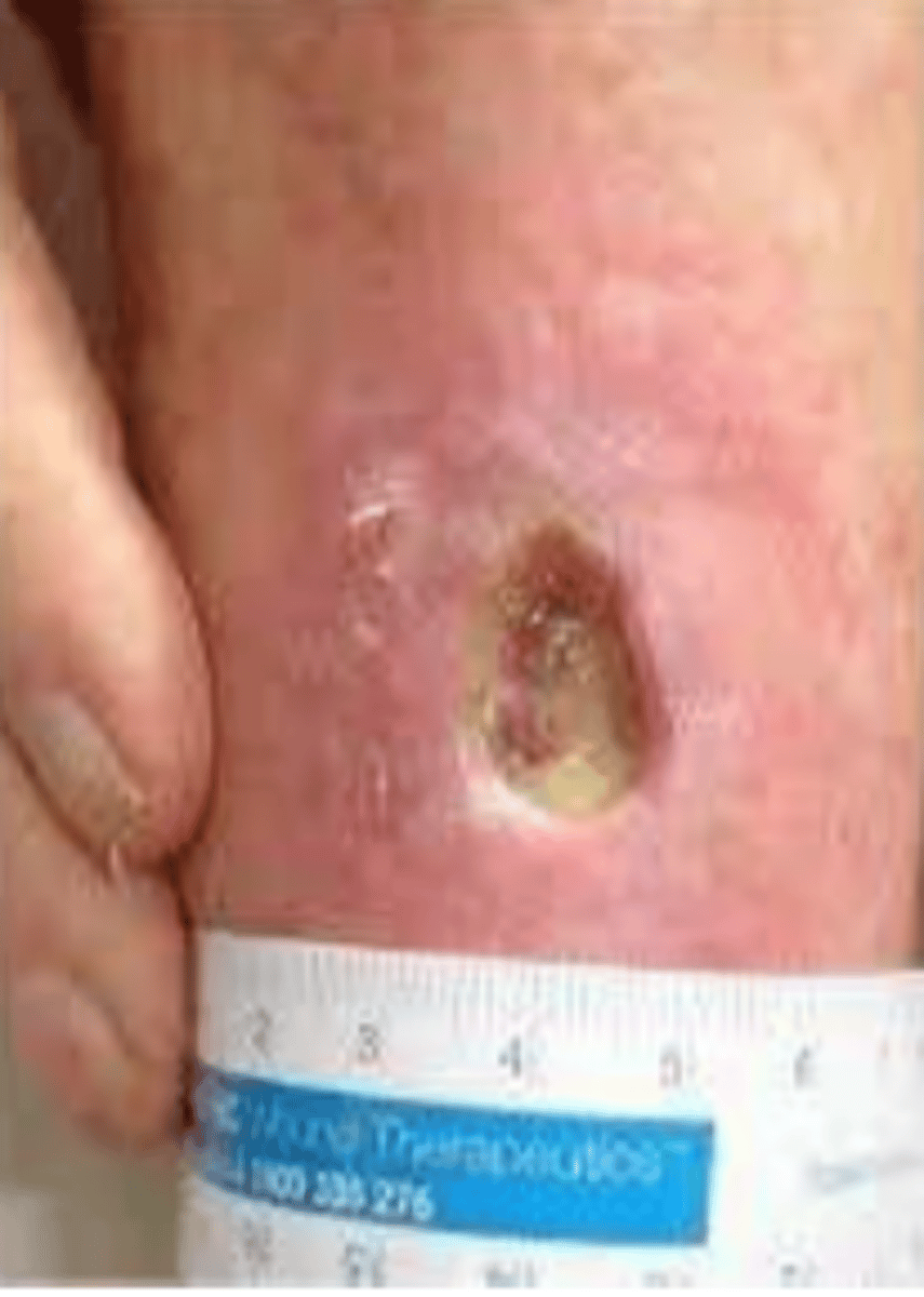 <p>causes: poor O2/CO2 diffusion, inadequate blood flow</p><p>signs and symptoms: intermittent claudication, dependent rubor, white skin, tissue death, mild to moderate edema, weak pulse (1+)</p><p>clinical presentation: round, regular border, punched out, pink wound bed, dry necrotic tissue, usually distal, minimal drainage, pain in elevated position</p><p>treatment: dressing to provide moisture and prevent infection, restore BF</p>