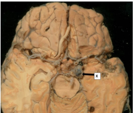 <p>Which statement(s) are correct concerning structure X?</p><p>i. This is a tumour of the Circle of Willis</p><p>ii. This is an aneurysm of the Circle of Willis</p><p>iii. Risk factors for this include genetics and alcohol abuse.</p><p>iv. Risk factors for this include high blood pressure, genetics and head injury</p>