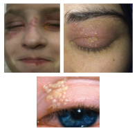 <p>What is the most likely diagnosis ?</p>