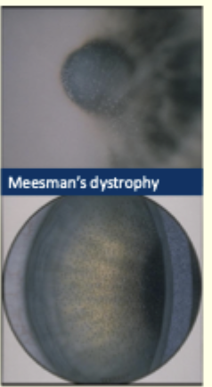 <p>Describe the image and give diagnosis</p>