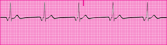 <p>Which rhythm is this?</p>