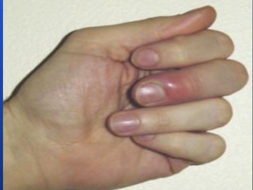 <p>Inflammation of the paronychium (tissue surrounding the nail).</p>