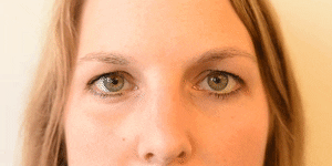<p>Lip Droop</p>