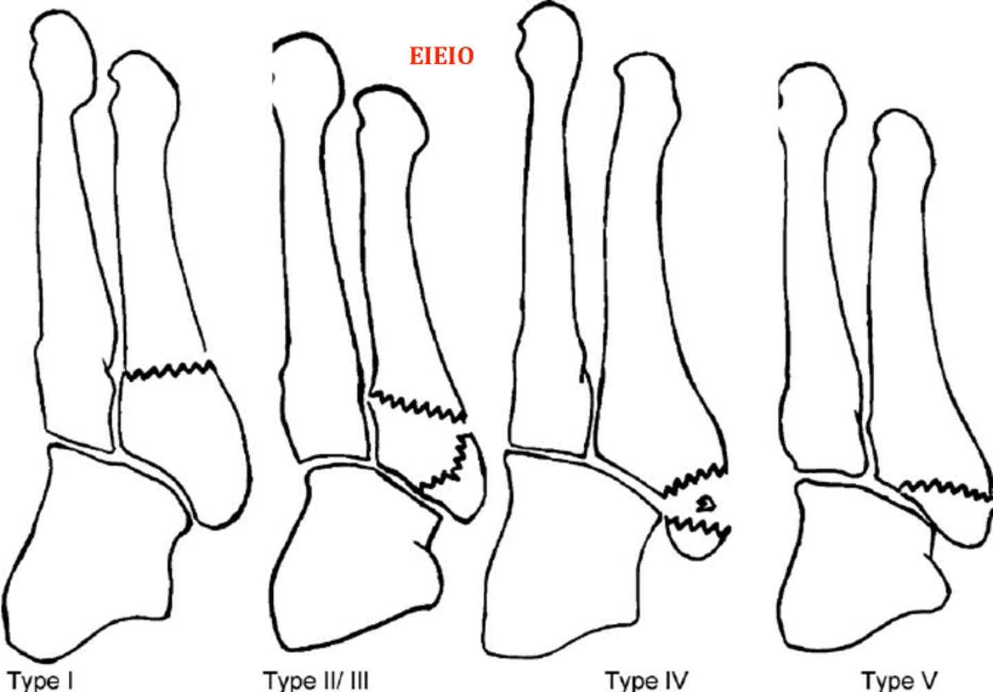 <p>5th Metatarsal Fractures</p><p>Type 1 - extra-articular fracture at metaphyseal-diaphyseal junction (true Jones fracture)</p><p>Type 2 - intra-articular avulsion fracture of 5th metatarsal base</p><p>Type 3 - extra-articular avulsion fracture of styloid process of 5th metatarsal base</p><p>Type 4 - intra-articular comminuted fracture of 5th metatarsal base</p><p>Type 5 - extra-articular avulsion of epiphysis in children</p>
