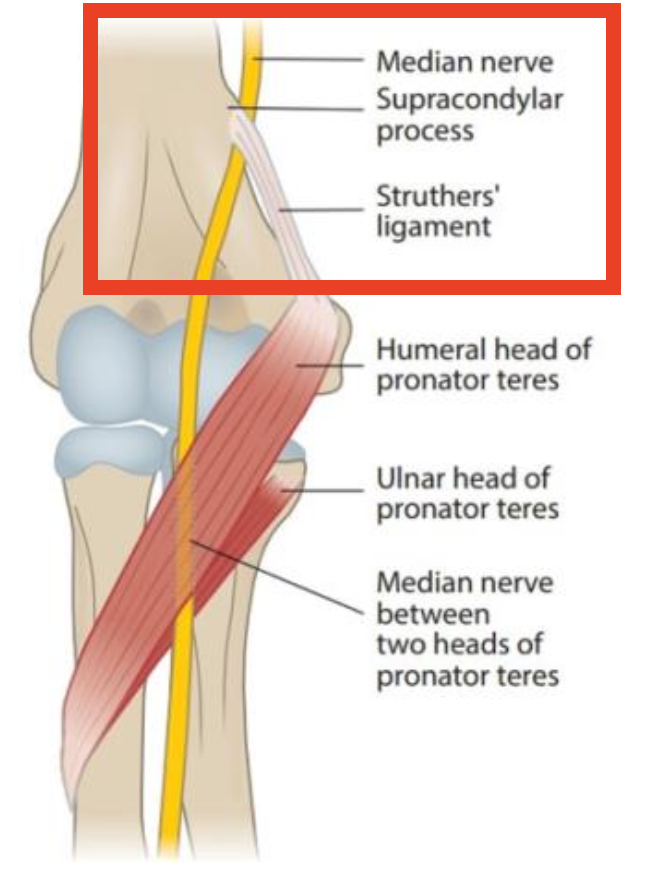 <p>Compression of the median nerve under the Struthers’ Ligament</p>