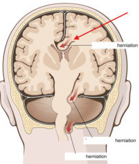 <p>What kind of herniation is this?</p>