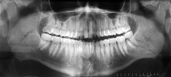 <p>Patient is slumped; correct by standing up straight / elongating spine</p>
