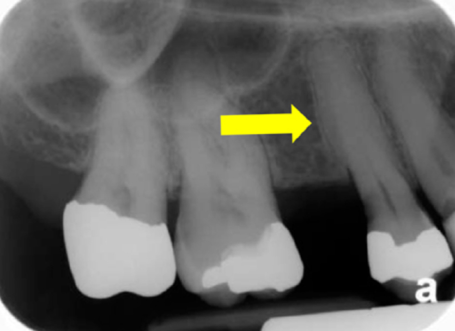 <p>Appears more radiolucent than either enamel or dentin but more radiopaque than pulp tissue</p>