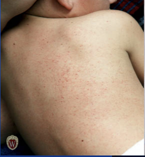 <p>Small red or purple spots often caused by platelet disorders. (<5 mm)</p>
