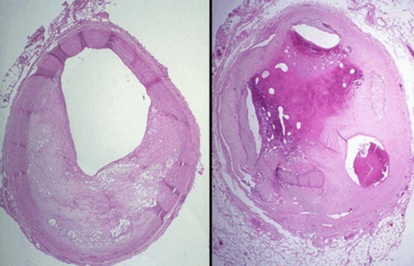 <p>open or unobstructed lumen such as ducts vessels or bowel</p>