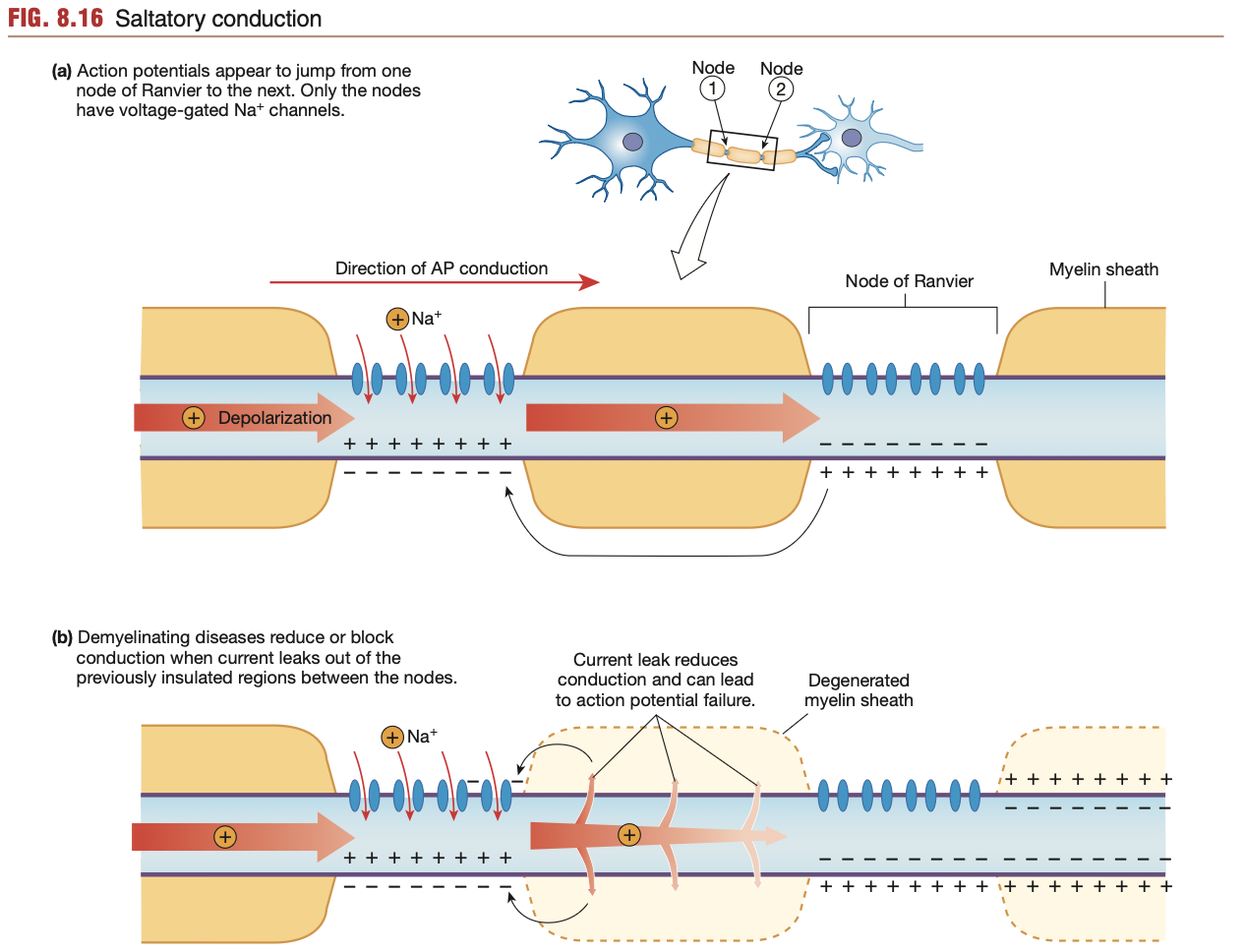 <ul><li><p>In unmyelinated axons, opening of voltage-gated Na+ channels along the entire axon takes time, especially in long neurons</p></li></ul><p>Process of <strong><mark data-color="yellow" style="background-color: yellow; color: inherit;">Saltatory conduction</mark>:</strong></p><ol><li><p>Depolarisation occurs at the trigger zone/axon hillock</p></li><li><p>Initial batch of voltage-gated Na+ channels open, letting Na+ rush into the cell.</p></li><li><p>Eventually, the depolarising neuron membrane stops, as a myelin sheath is reached (sometimes Schwann cell)  </p></li><li><p>In myelinated axons, voltage-gated Na+ channels along the axon can only be found along the <strong><mark data-color="red" style="background-color: red; color: inherit;">nodes of Ranvier</mark></strong> (refer to diagram)</p></li><li><p>Hence, the inner steep Na+ gradient (from previously opened voltage-gated Na+ channels is able to rush past myelin sheath segments inside the neuron without risk of Na+ leaking out from leaky channels. (i.e <strong>no current leak</strong>)</p></li><li><p>Hence, myelin sheaths allow the axon potential to “skip” along nodes of Ranvier, while also preventing leaks of Na+ ions from leaky channels.</p></li></ol><ul><li><p><mark data-color="green" style="background-color: green; color: inherit;">More myelin sheath, the faster an action potential, the less likelihood of an action potential dissipating</mark></p></li></ul><p></p><p>Lack of a myelin sheath can hinder action potentials greatly, as found in ailments such as <strong>multiple sclerosis</strong> (degradation of myelin sheath).</p>