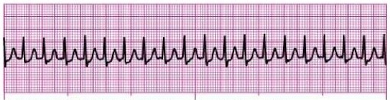 <p>What is the treatment for this rhythm?</p>