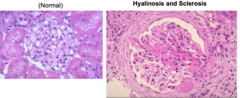<p>- chronic hypertension</p><p>- obesity/diabetes mellitus</p><p>- glomerulonephritis</p>