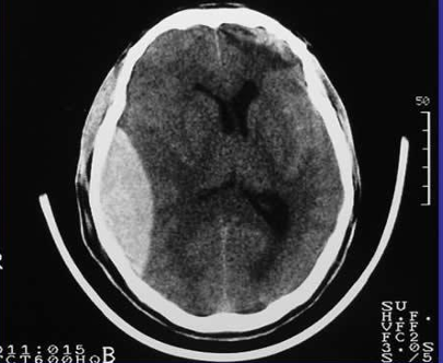<p>Con la siguiente imagen, cual seria su diagnostico probable </p>