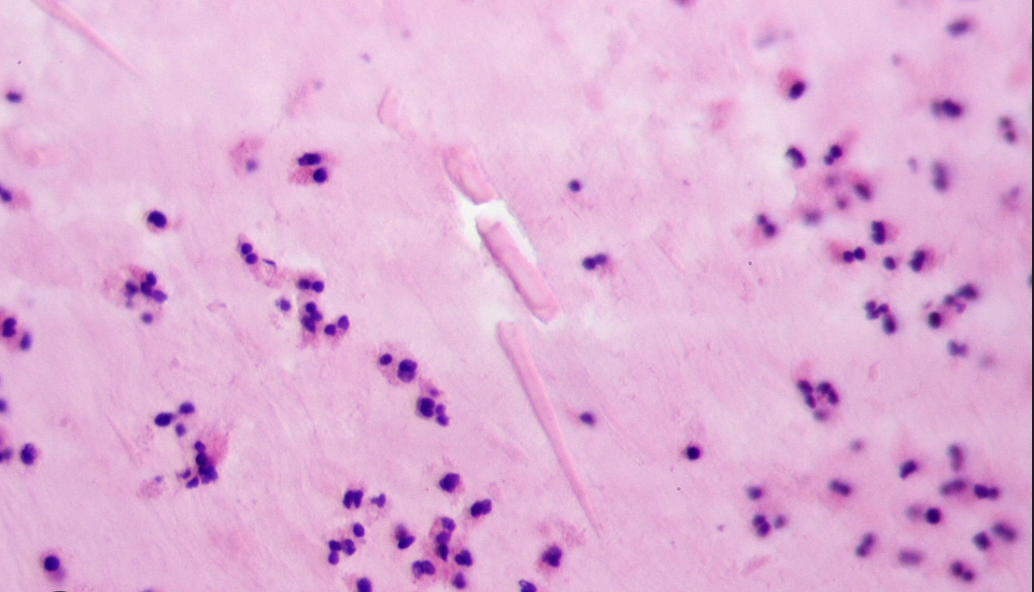 <p>Charcot–Leyden crystals</p><p>*Elongated, needle-like or bipyramidal crystals</p><p>*<span style="font-size: calc(var(--scale-factor)*32.02px);"><span>possible indicator of infection with</span></span><span><span><br></span></span><span style="font-size: calc(var(--scale-factor)*32.00px);"><span>Entamoeba histolytica</span></span></p><p><span>*In stool (commonly, not exclusive)</span></p>